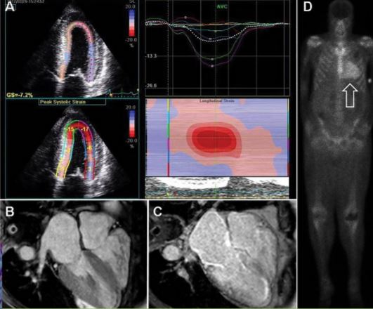 Diagnosing Amyloidosis: From Cardiology To Neurology Diagnosing Amyloidosis: From Cardiology To Neurology